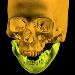 Read more about the article Distraction Osteogenesis on Mandible