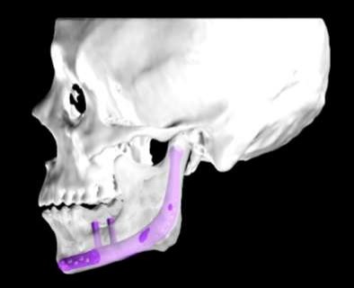 You are currently viewing Design of mandibular implants