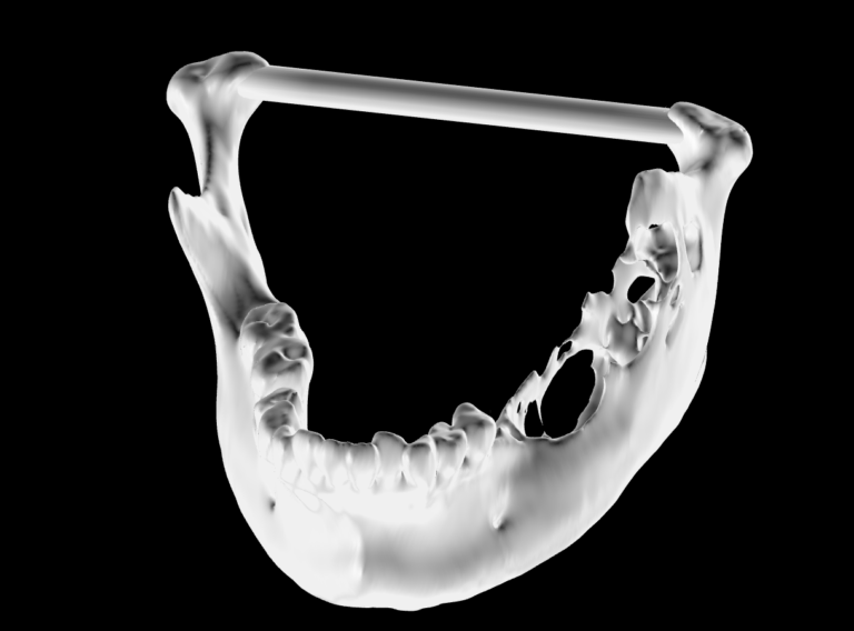 Read more about the article Surgery for a mandibular tumour