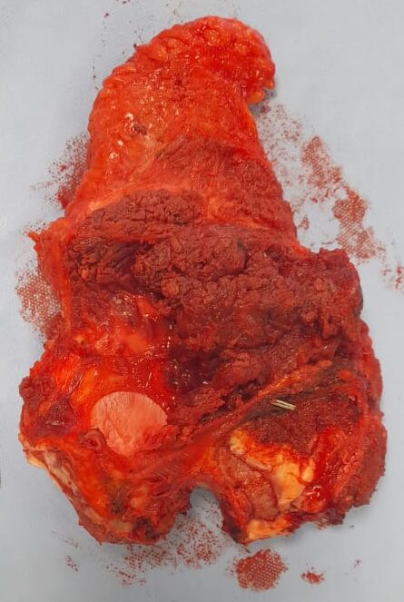 Read more about the article Malignancy in the hemi-pelvis