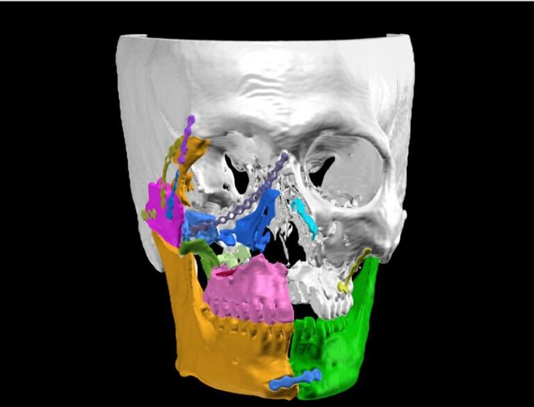Read more about the article Revision fracture of the skull