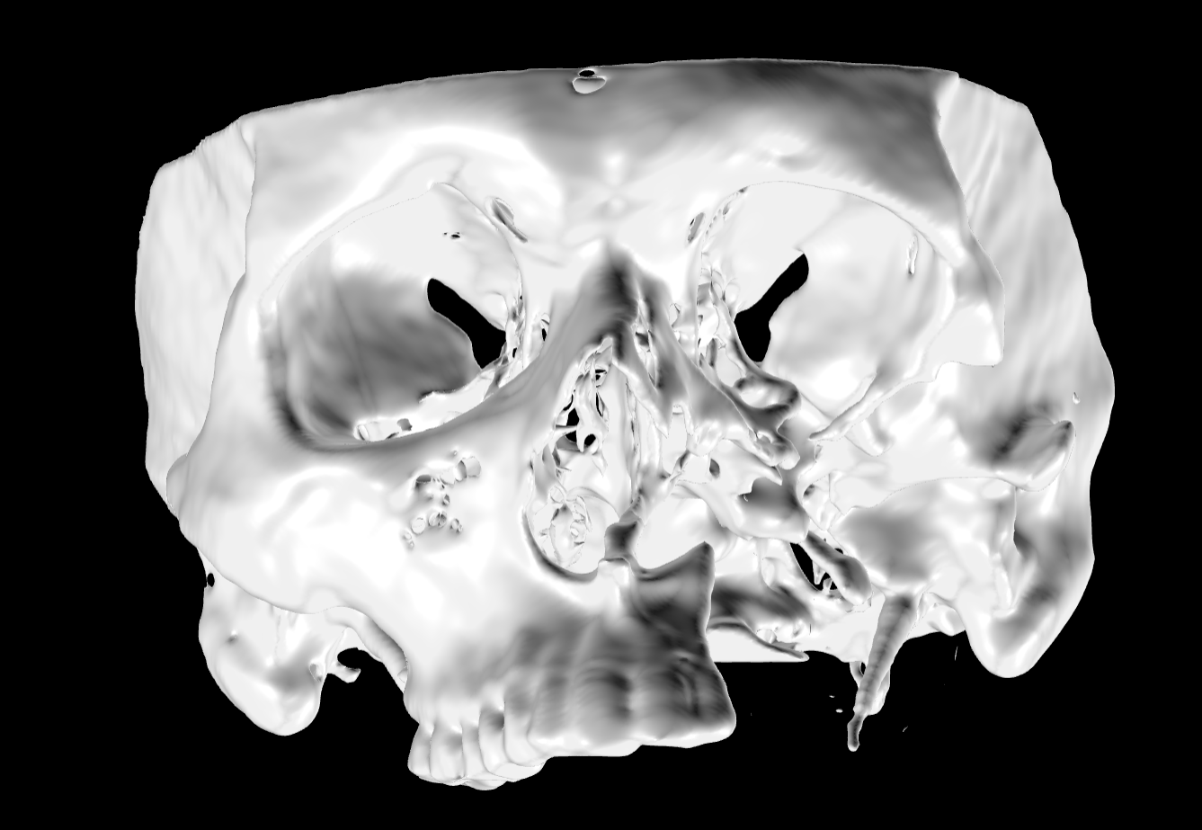 Read more about the article Total maxillectomy on the left side