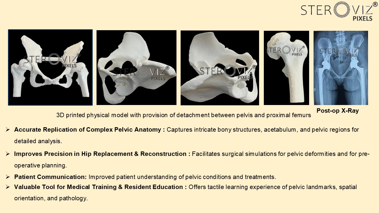 Anatomical Model for Avascular Necrosis