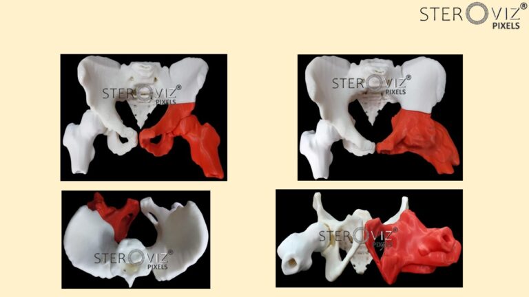 Read more about the article Anatomical Model for Pelvic Onco Surgery