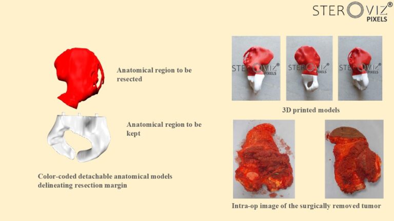 Read more about the article Anatomical Model for Hemipelvic Onco Surgery