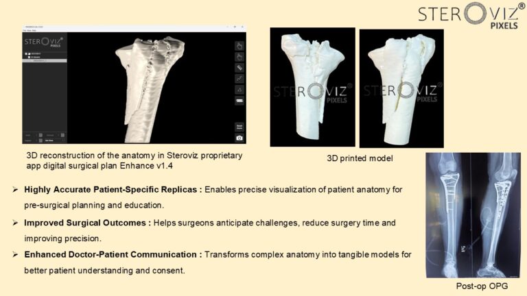 Read more about the article Anatomical Model for Proximal Tibia Fracture