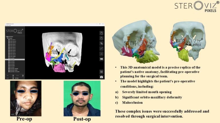 Read more about the article Anatomical Model for Revision Surgery Planning of Skull