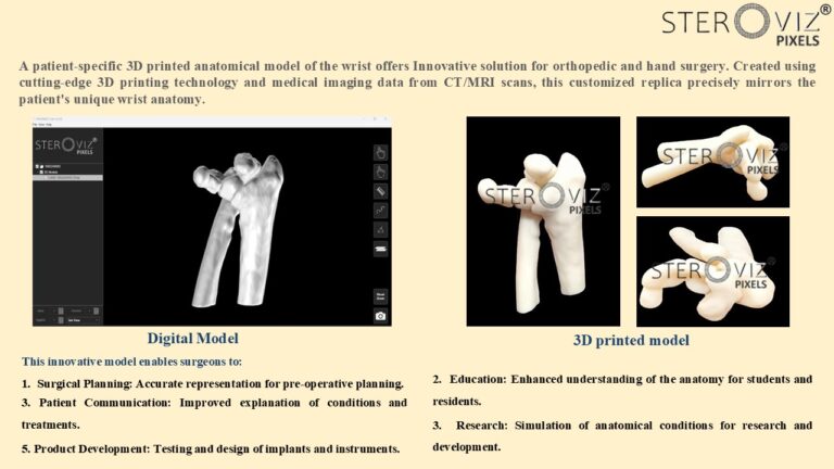 Read more about the article Anatomical Model for Wrist Fracture