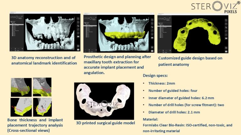Read more about the article Surgical Cutting Guide All-on-Four Implant