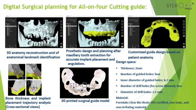 Read more about the article Surgical Cutting Guide All-on-Four Implant