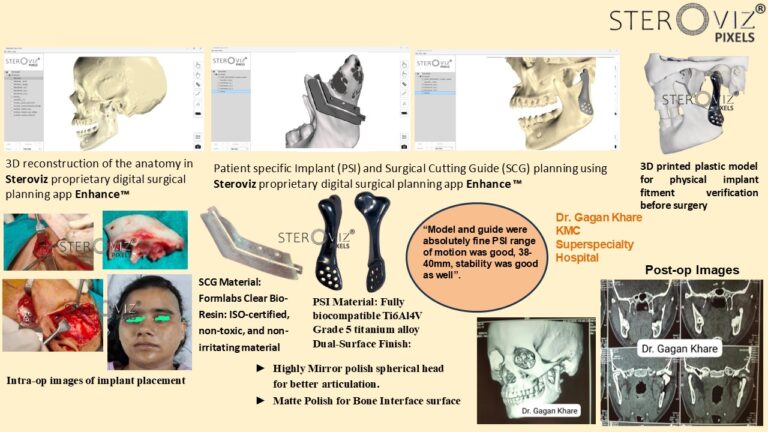 Read more about the article Custom Condylar Implant