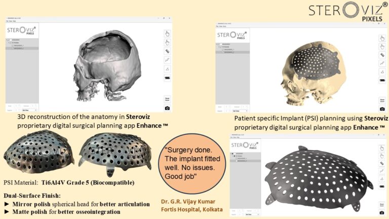 Read more about the article Custom Cranial Implant