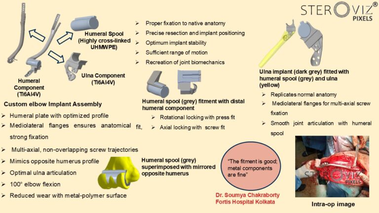 Read more about the article Custom Elbow Implant