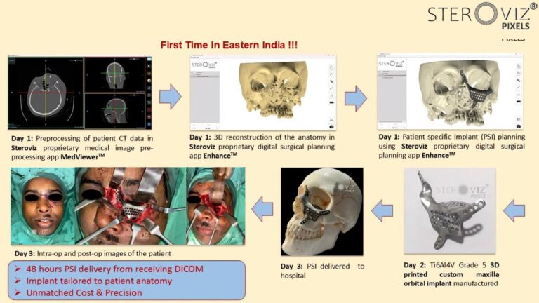 Read more about the article Custom Maxillary Orbital Implant