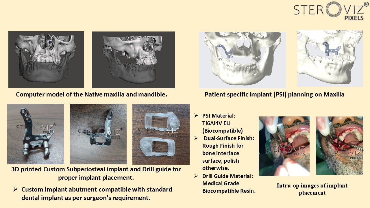 Custom Maxillary Subperiosteal Implant