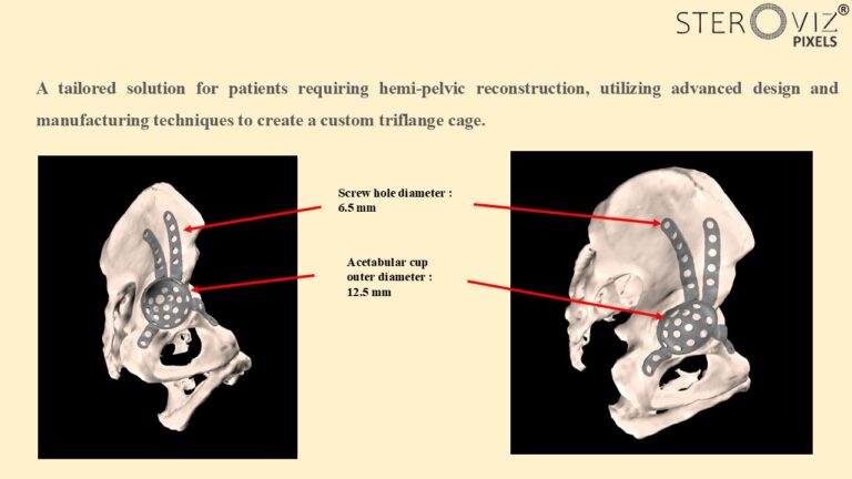 Read more about the article Custom Triflange Cage