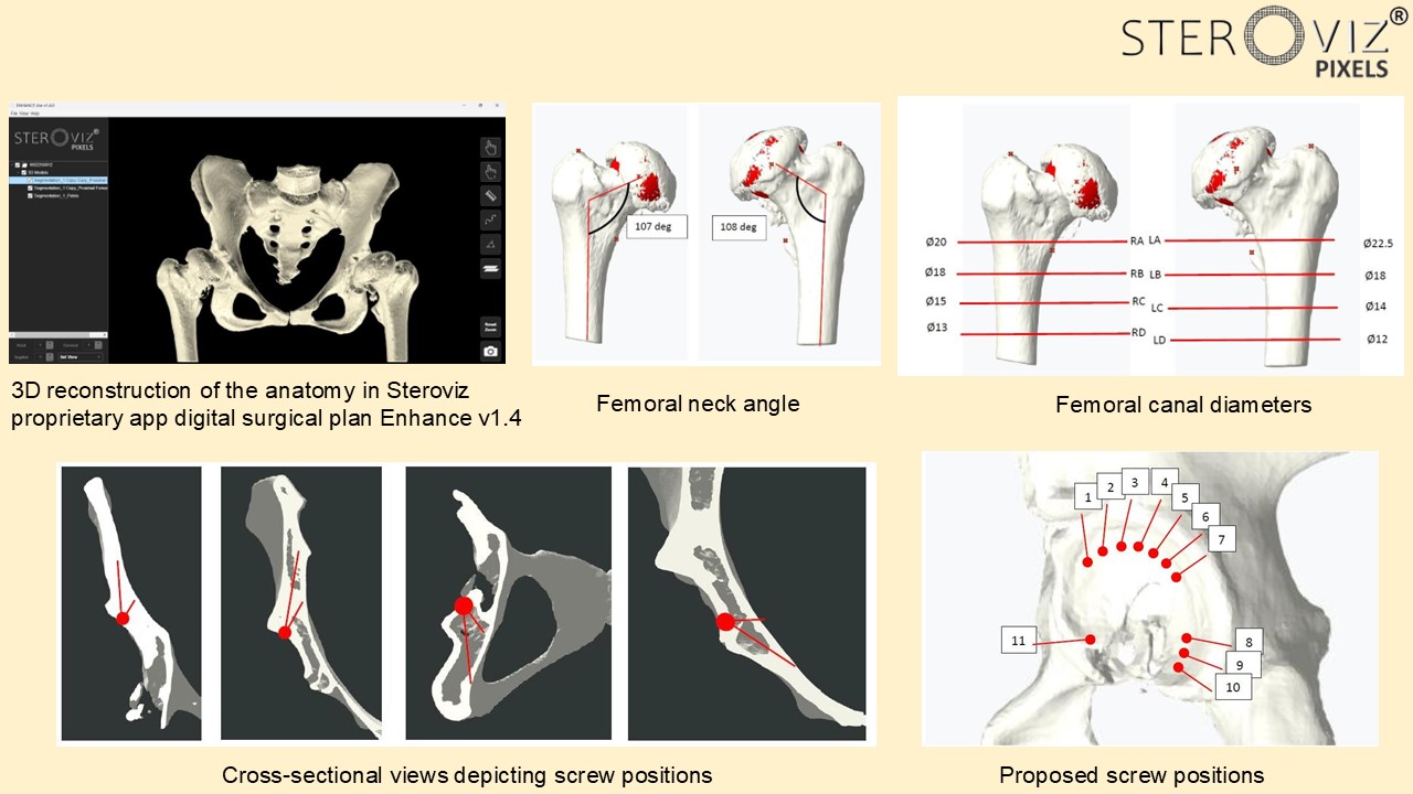 Digital Planning for Avascular Necrosis