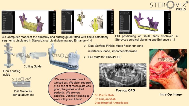 Read more about the article Digital Planning for Free Fibula Flap & Mandibular Pre-bent Plate