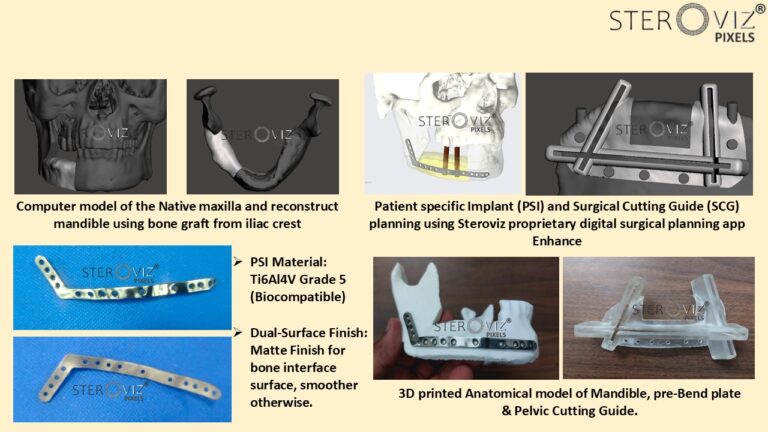 Read more about the article Digital Planning for Free Fibula Flap from Iliac Crest , Cutting Guide & Mandibular Pre-bent Plate