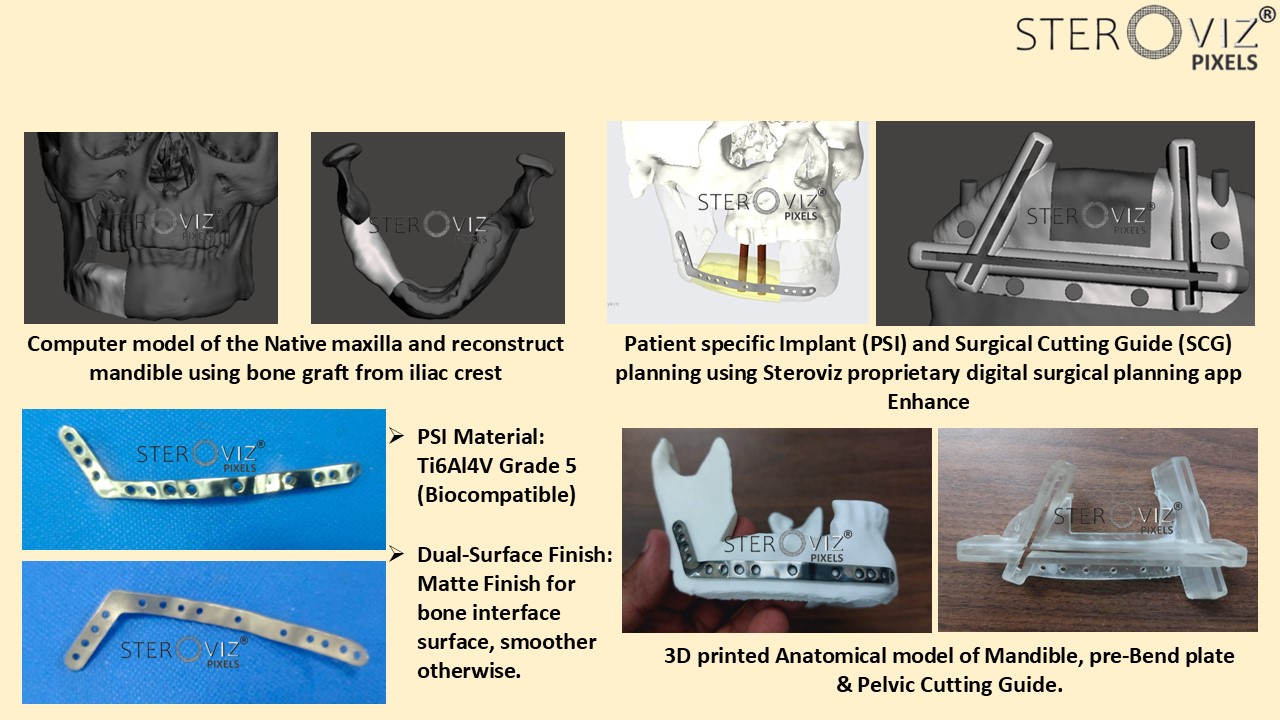 Digital Planning for Free Fibula Flap from Iliac Crest , Cutting Guide & Mandibular Pre-bent Plate