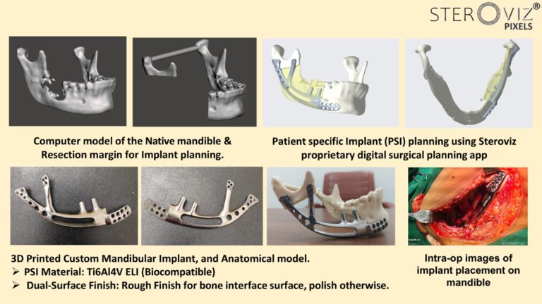 Read more about the article Custom Mandibular Implant