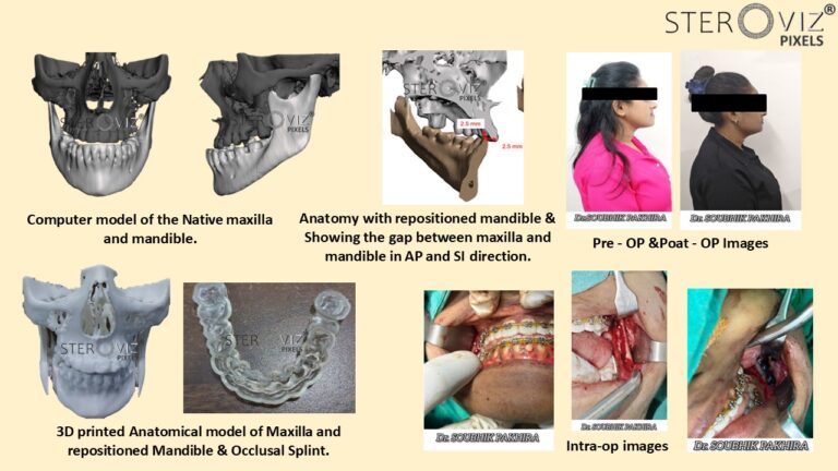 Read more about the article Orthognathic Planning & Occlusion Splint