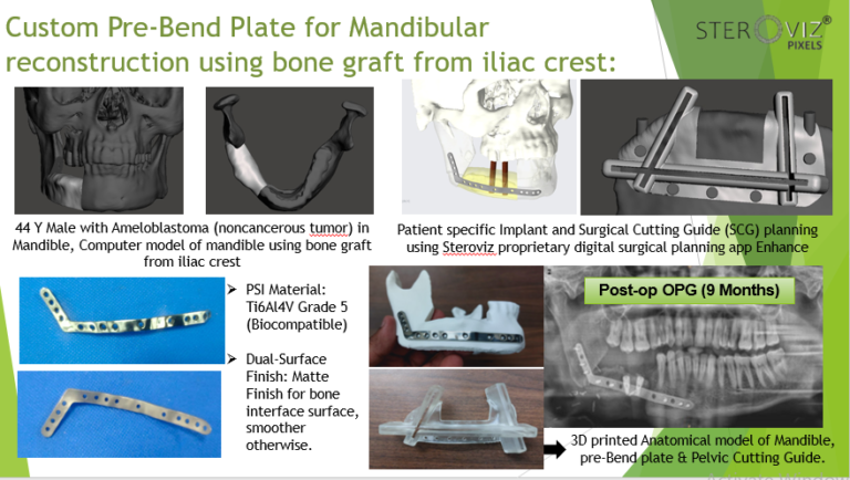 Read more about the article Digital Planning for Free Fibula Flap from Iliac Crest , Cutting Guide & Mandibular Pre-bent Plate