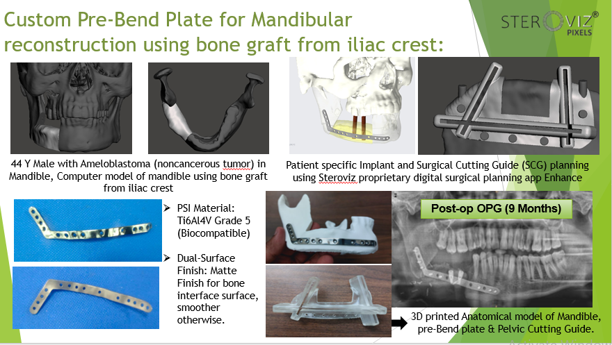 Read more about the article Digital Planning for Free Fibula Flap from Iliac Crest , Cutting Guide & Mandibular Pre-bent Plate