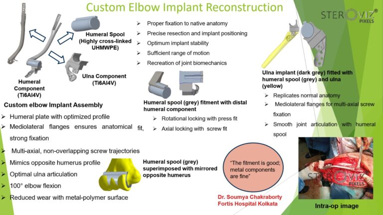 Read more about the article Custom Elbow Implant