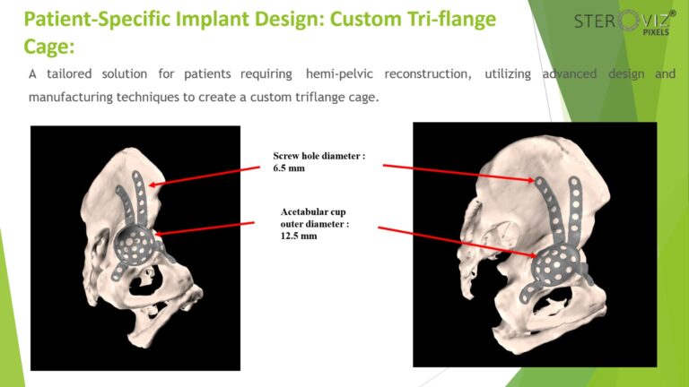 Read more about the article Custom Triflange Cage