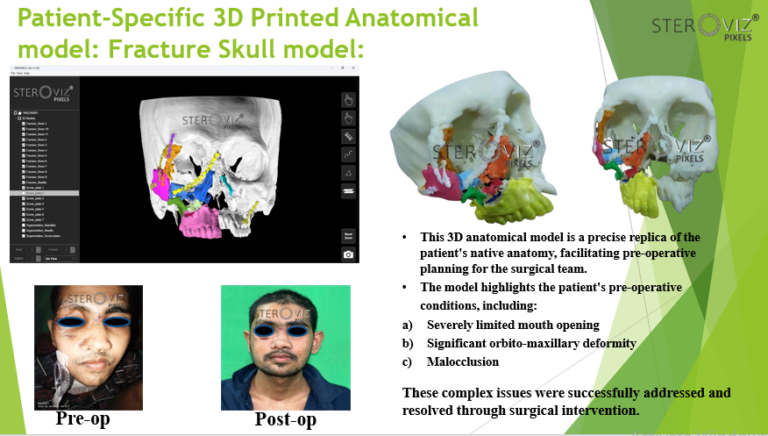 Read more about the article Anatomical Model for Revision Surgery Planning of Skull