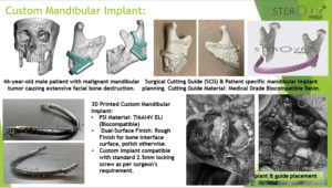 Read more about the article Custom Mandibular Implant: