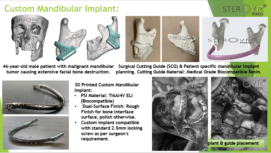 Custom Mandibular Implant: