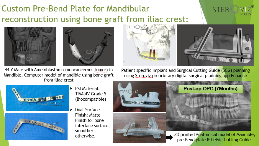 Digital Planning for Free Fibula Flap from Iliac Crest , Cutting Guide & Mandibular Pre-bent Plate