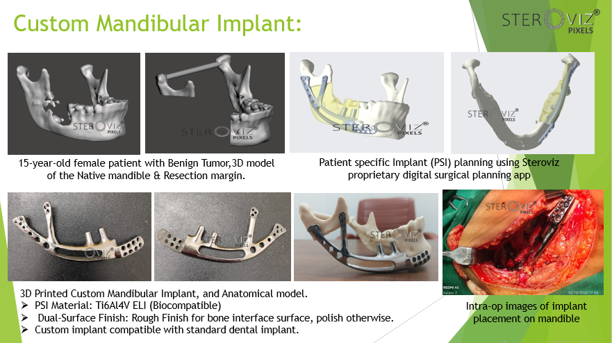 Custom Mandibular Implant