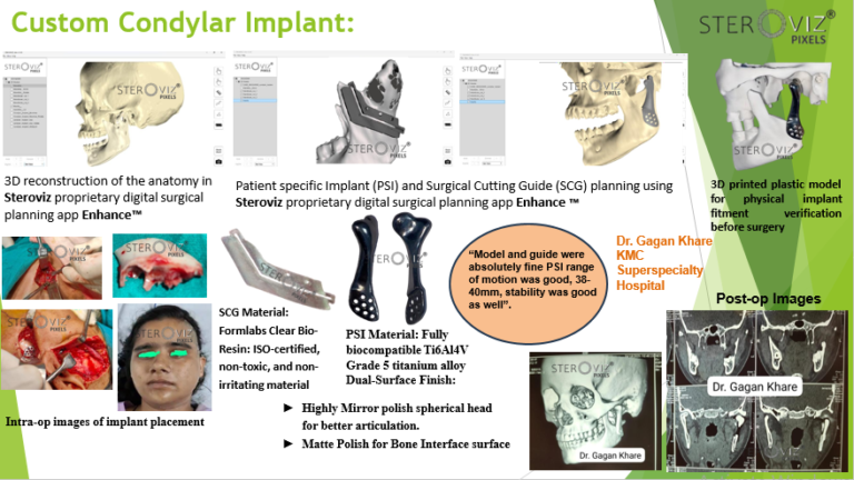 Read more about the article Custom Condylar Implant