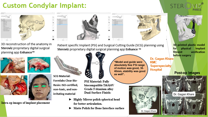 Custom Condylar Implant