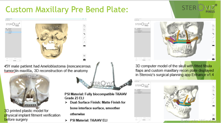 Read more about the article Free Fibula Flap Planning & Maxillary Pre-bent Plate