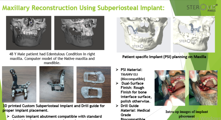Read more about the article Custom Maxillary Subperiosteal Implant