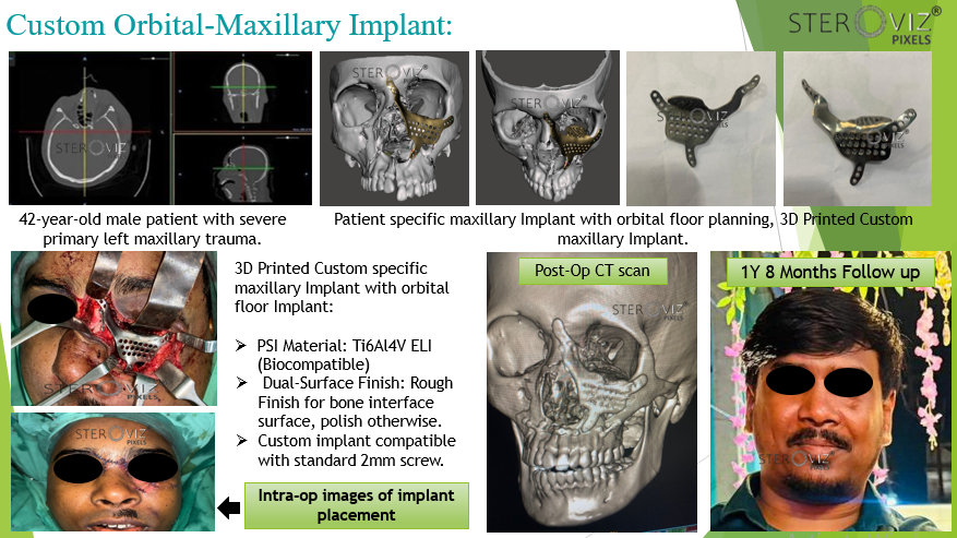 Custom Maxillary Orbital Implant