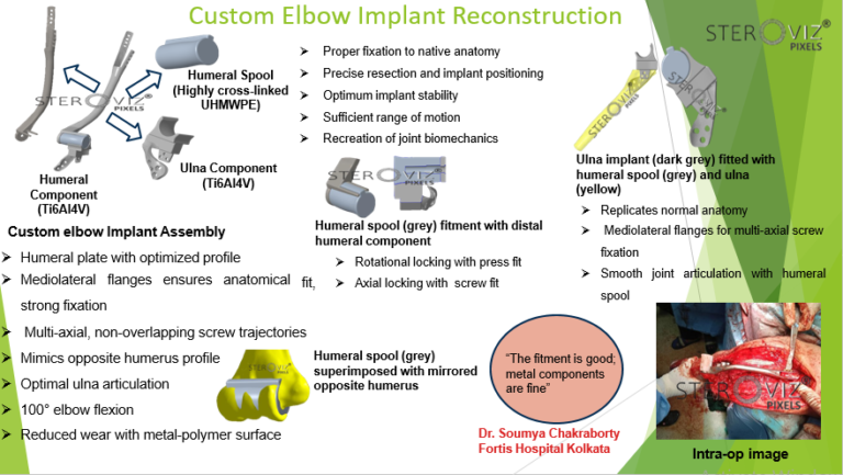Read more about the article Custom Elbow Implant