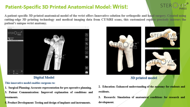 Read more about the article Anatomical Model for Wrist Fracture