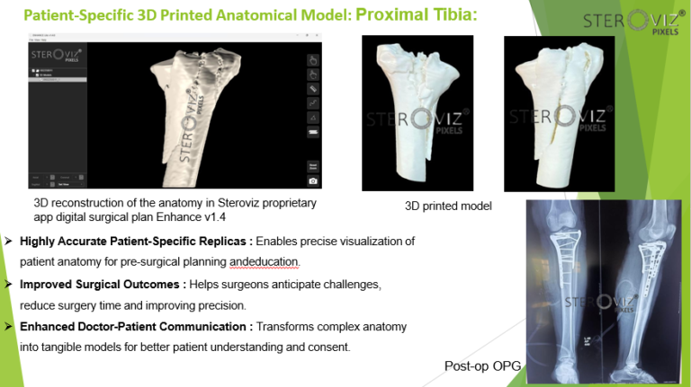 Read more about the article Anatomical Model for Proximal Tibia Fracture