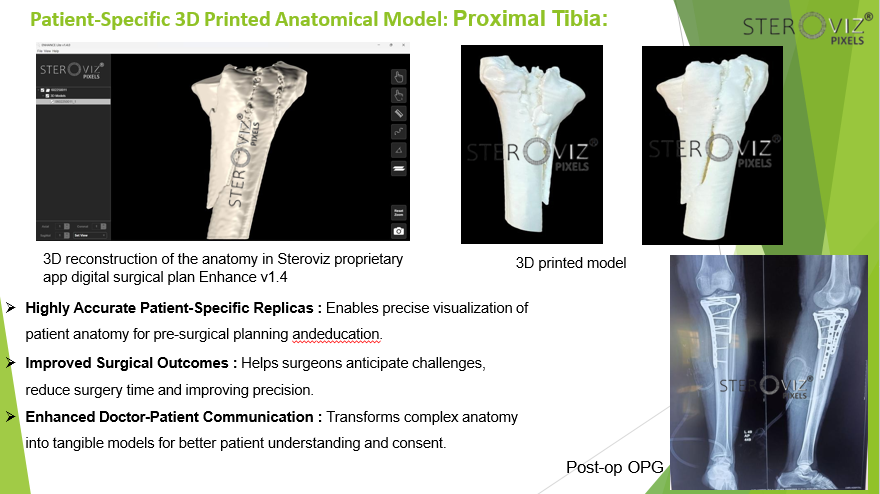 Anatomical Model for Proximal Tibia Fracture