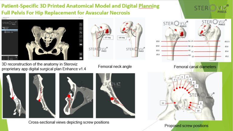 Read more about the article Digital Planning for Avascular Necrosis
