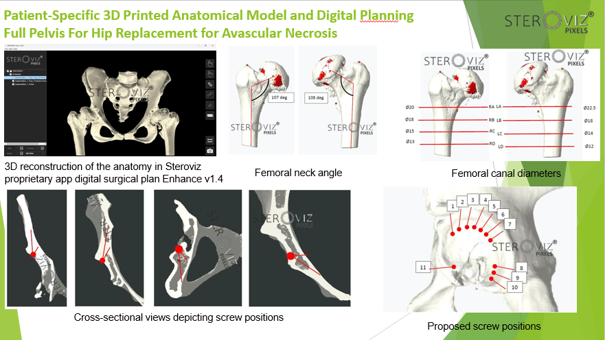 Digital Planning for Avascular Necrosis