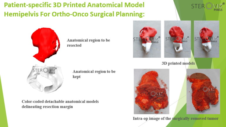 Read more about the article Anatomical Model for Hemipelvic Onco Surgery