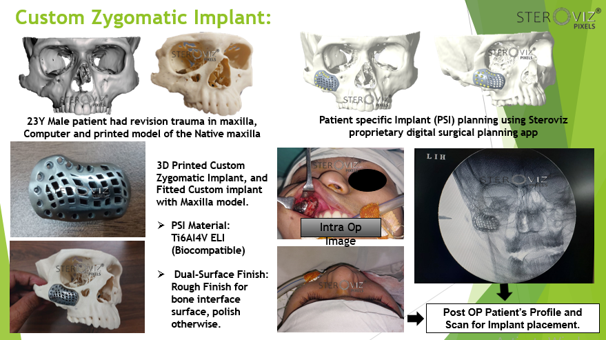 Custom Zygomatic implant
