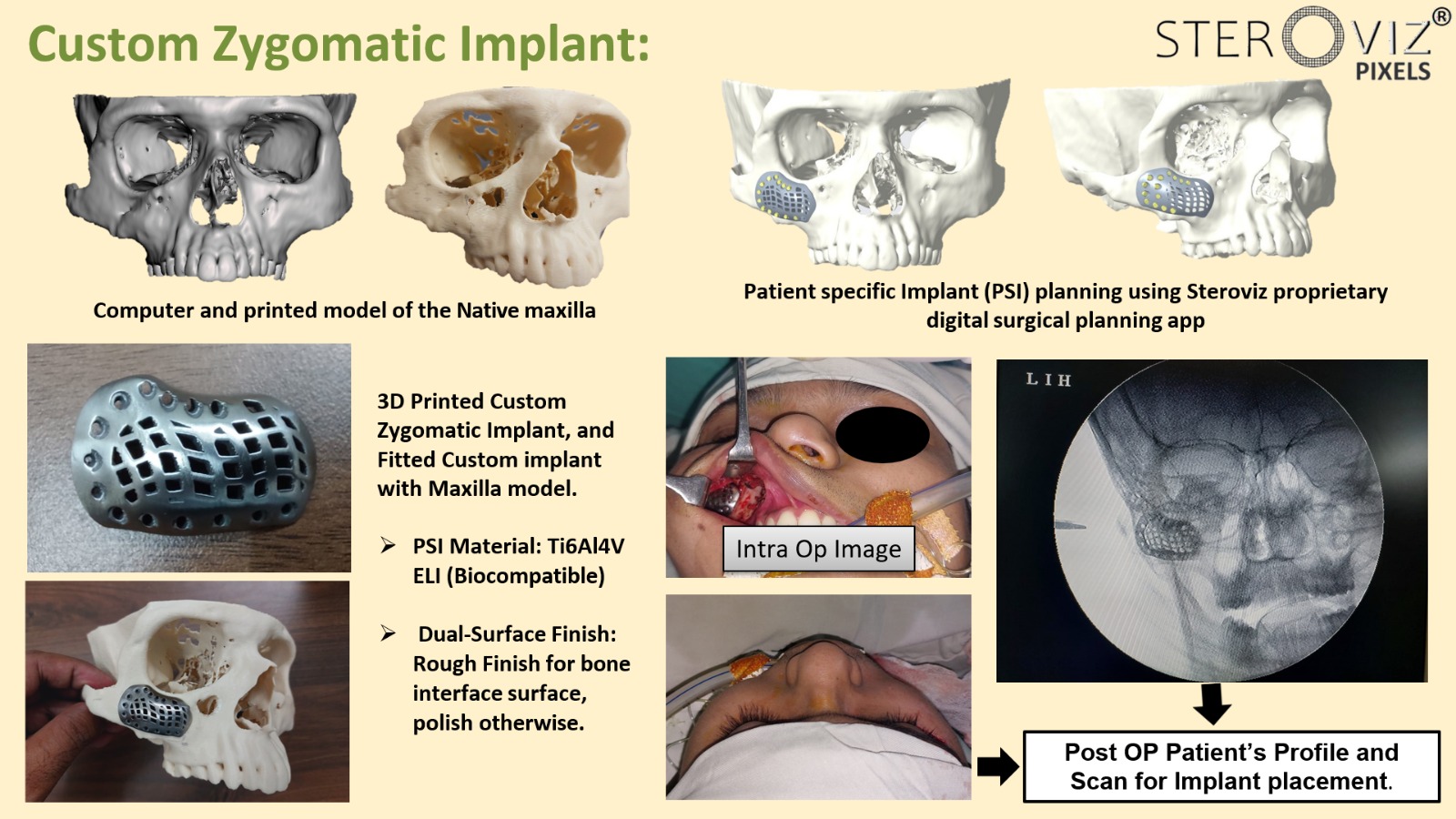 Custom Zygomatic implant