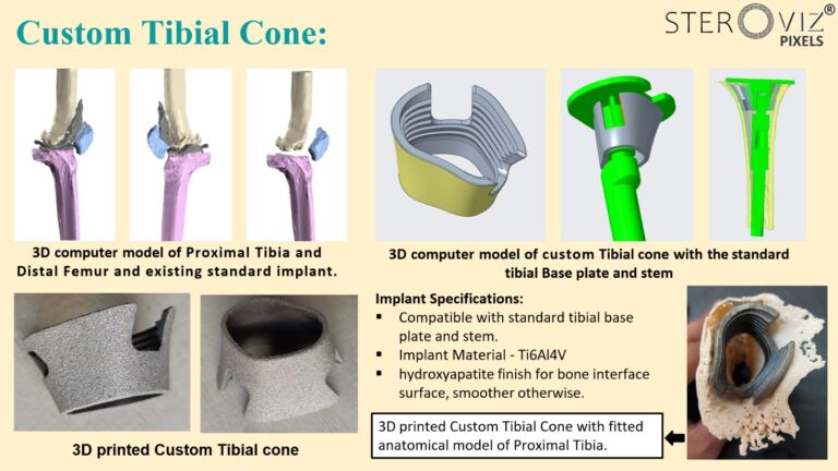 Read more about the article Custom Tibial Cone
